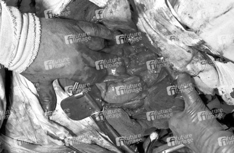 Operation 'Blaues-Baby-Krankheit'