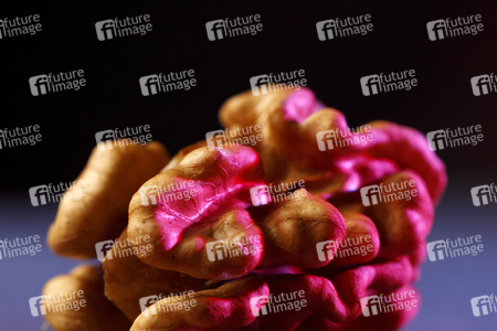 Symbolfoto Hirnthrombose