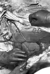 Operation 'Blaues-Baby-Krankheit'