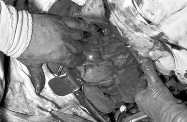 Operation 'Blaues-Baby-Krankheit'