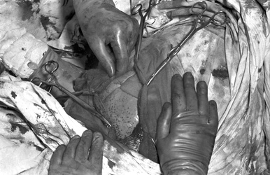 Operation 'Blaues-Baby-Krankheit'